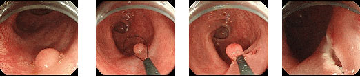 内視鏡的粘膜切除術（Endoscopic mucosal resection:EMR）
