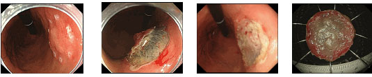 内視鏡的粘膜下層剥離術（Endoscopic submucosal dissection:ESD）
