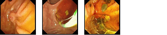 内視鏡的十二指腸乳頭切開術（EST）と砕石術